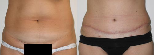 Before and After - Patient Y