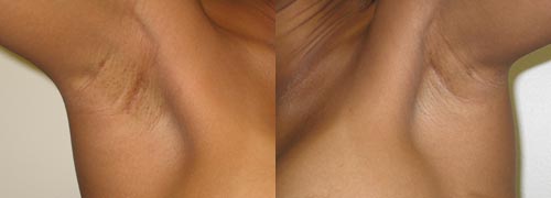 Before and After - Axillary scar